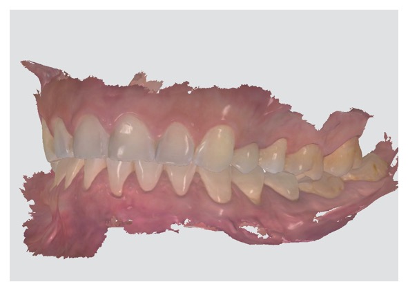 Escaner Intraoral 3D Moldes